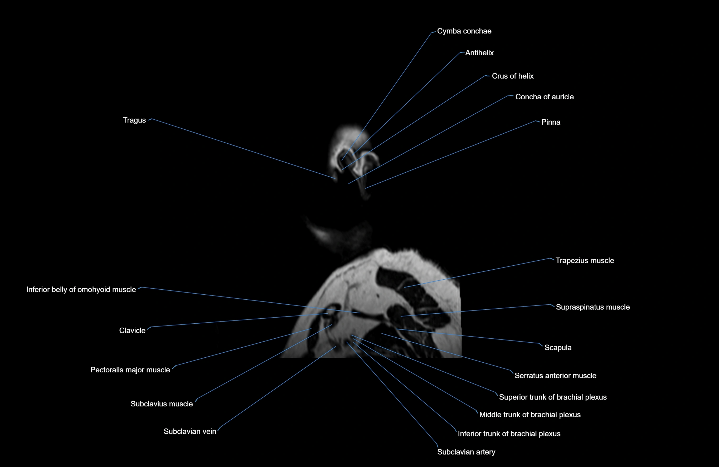 Neck MRI sagittal cross sectional anatomy 3D 1mm 3T radiology  image-img-00001-00045.webp